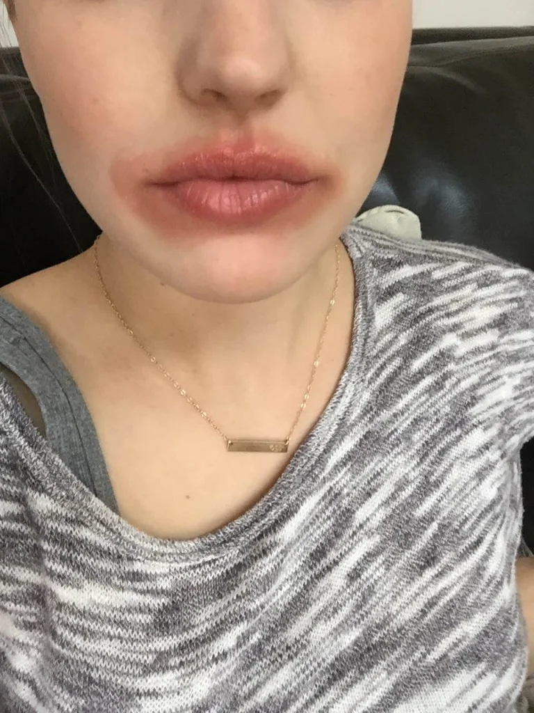 My Perioral Dermatitis — Laurenda Marie